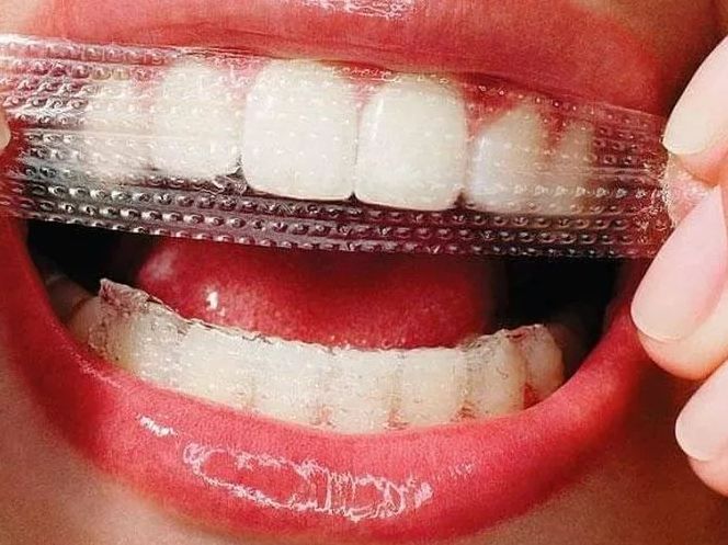 Профессиональное отбеливание зубов в домашних условиях. Отбеливающие полоски Crest – преимущества и недостатки