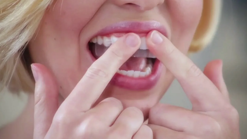 Профессиональное отбеливание зубов в домашних условиях. Отбеливающие полоски Crest – преимущества и недостатки