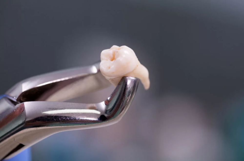 Почему не стоит откладывать удаление зуба